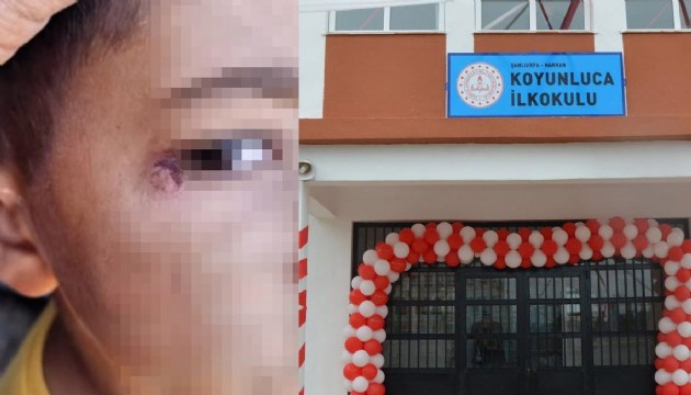 Temizlik görevlisi çocuğun yüzünde sigara söndürdü