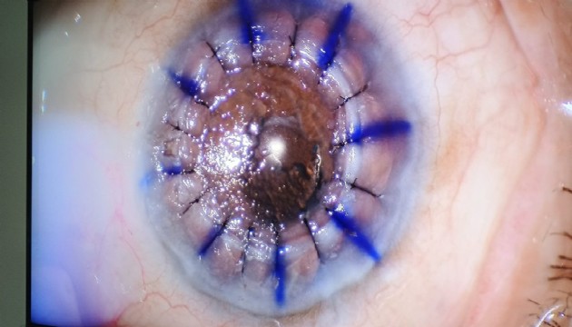 83 yaşındaki hastaya 46 yıl önce bağışlanan kornea nakledildi