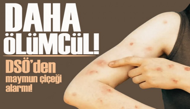 DSÖ'den maymun çiçeği alarmı: 'klad 1b' varyantı daha ölümcül