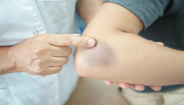 Uzmanlar cildin neden kolay morardığını anlattı