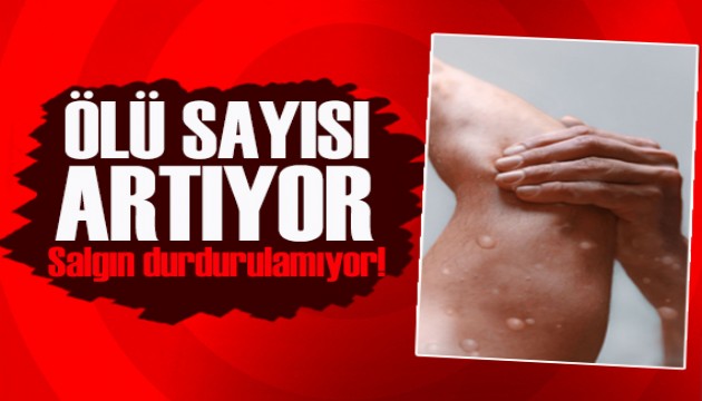 M çiçeği virüsünde ölü sayısı artıyor