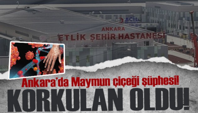 Ankara'da Maymun çiçeği şüphesi: 4 kişi karantina altında