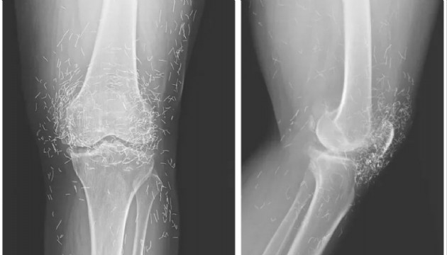 Dizindeki ağrı için gitti, röntgende yüzlerce altın iplik bulundu