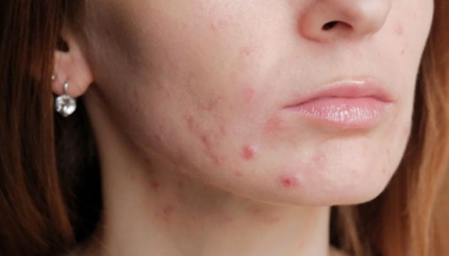 Van'da 4 kişi sivilce kreminden hastanelik oldu