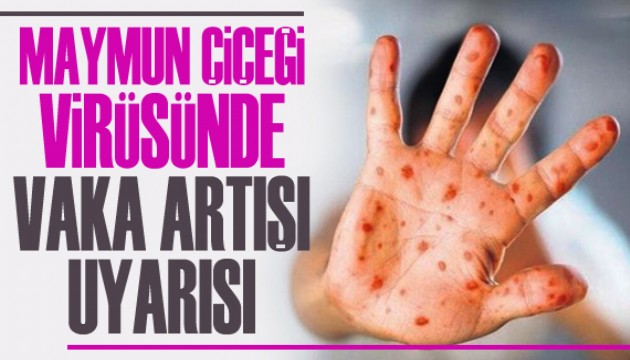 DSÖ'den maymun çiçeğinde 'vaka artışı' uyarısı!