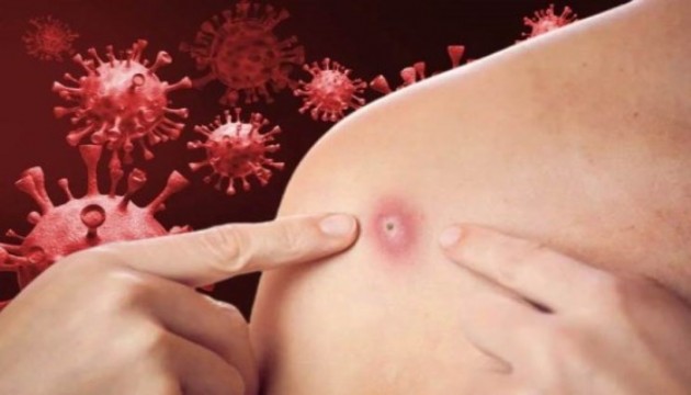 KDC'de Mpox alarmı: 5 ayda 9 binden fazla vaka