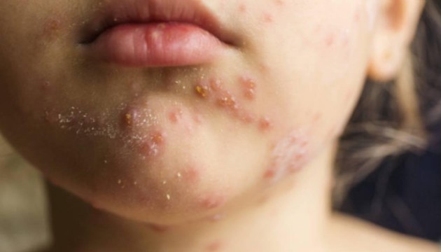 DSÖ: Avrupa Bölgesi'nde 2024'te 27 yıl sonra en yüksek kızamık vakaları görüldü