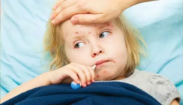 Uzmanı uyardı: Aşılanmamış her 10 çocuktan 9'u kızamık oluyor