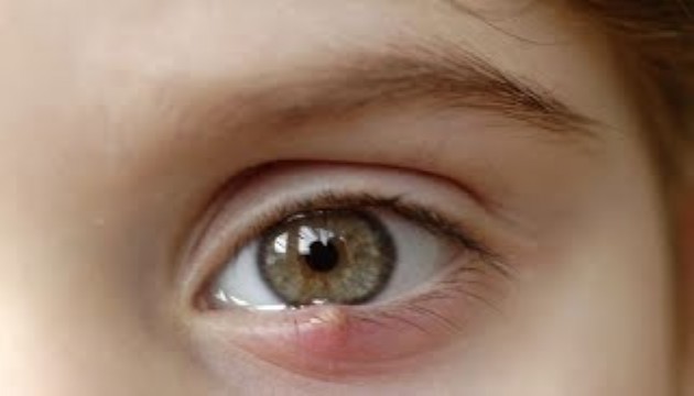 Son dönemlerde artan şikayet... Arpacık nedir, niçin oluşur?