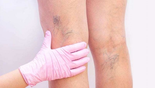 Uzmanı uyardı: Varis vücutta ‘Pıhtı' riskini artırabilir